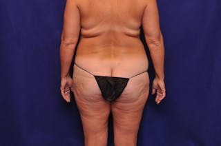 Liposuction Before & After Gallery - Patient 254203 - Image 12