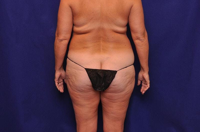 Liposuction Before & After Gallery - Patient 254203 - Image 12