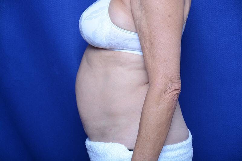 Liposuction Before & After Gallery - Patient 119161 - Image 2