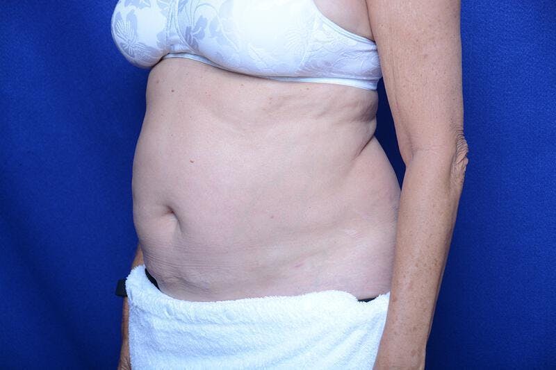Liposuction Before & After Gallery - Patient 119161 - Image 4