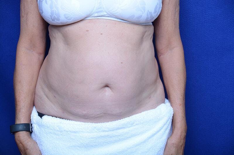 Liposuction Before & After Gallery - Patient 119161 - Image 6