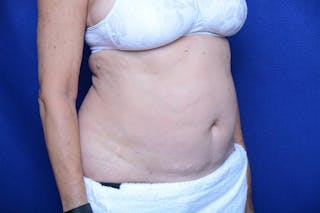 Liposuction Before & After Gallery - Patient 119161 - Image 8