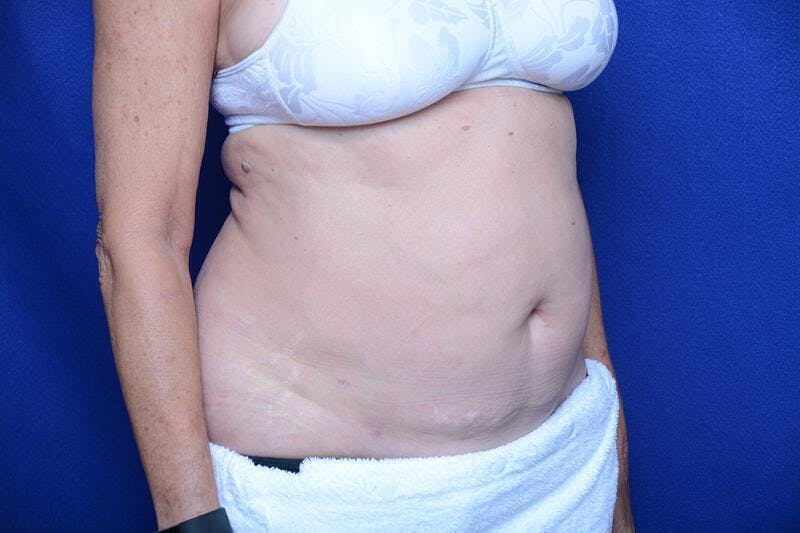 Liposuction Before & After Gallery - Patient 119161 - Image 8
