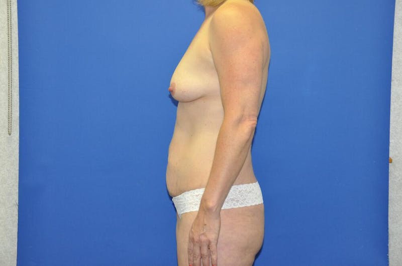 Mini Abdominoplasty Before & After Gallery - Patient 298305 - Image 1