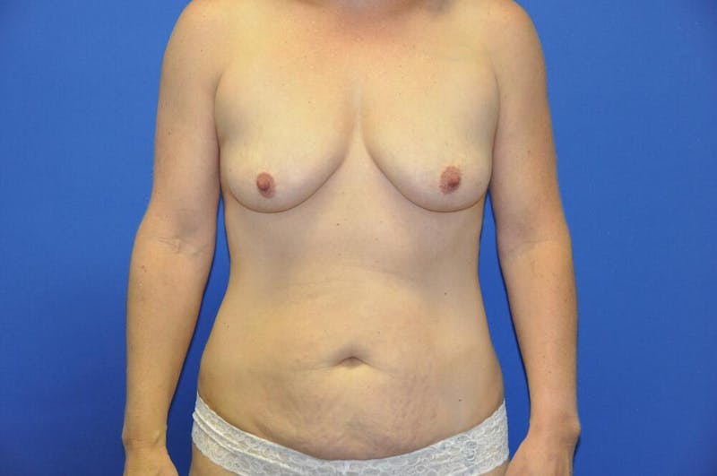 Mini Abdominoplasty Before & After Gallery - Patient 298305 - Image 5