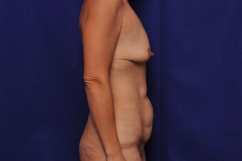 Mommy Makeover Before & After Gallery - Patient 300404 - Image 7