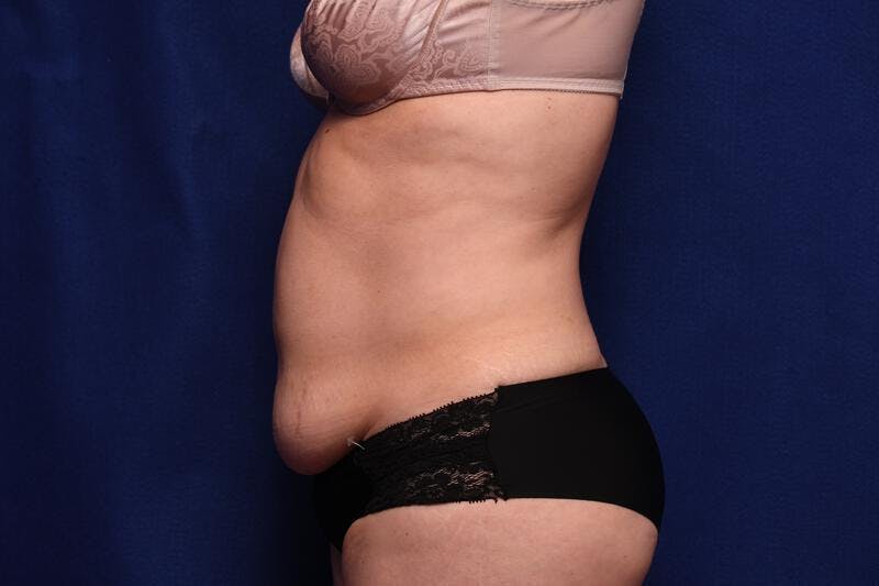Abdominoplasty Before & After Gallery - Patient 362604 - Image 1