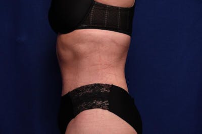Abdominoplasty Before & After Gallery - Patient 362604 - Image 2