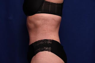 Abdominoplasty Before & After Gallery - Patient 362604 - Image 2