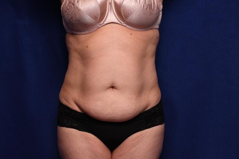 Abdominoplasty Before & After Gallery - Patient 362604 - Image 5