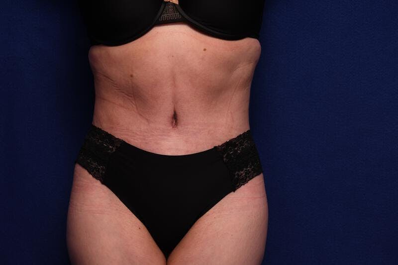 Abdominoplasty Before & After Gallery - Patient 362604 - Image 6