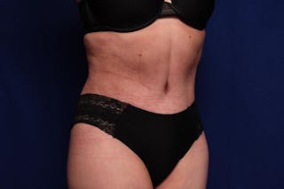 Abdominoplasty Before & After Gallery - Patient 362604 - Image 8