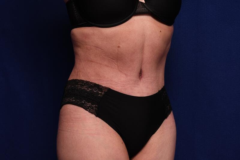 Abdominoplasty Before & After Gallery - Patient 362604 - Image 8