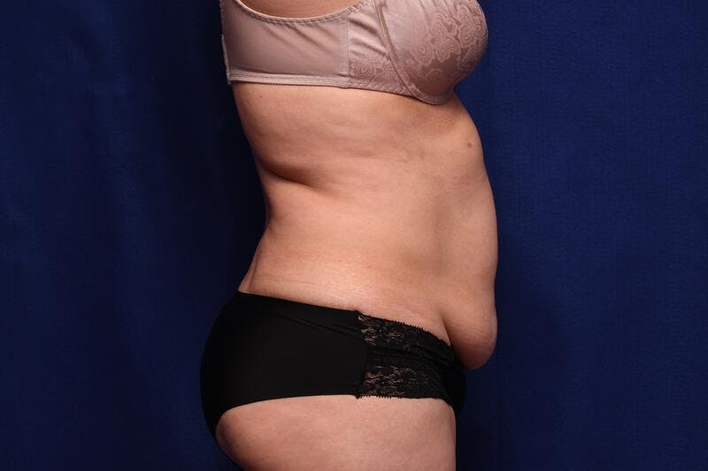 Abdominoplasty Before & After Gallery - Patient 362604 - Image 9