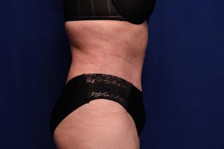 Abdominoplasty Before & After Gallery - Patient 362604 - Image 10