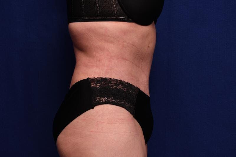 Abdominoplasty Before & After Gallery - Patient 362604 - Image 10