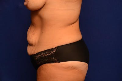 Abdominoplasty Before & After Gallery - Patient 325829 - Image 1