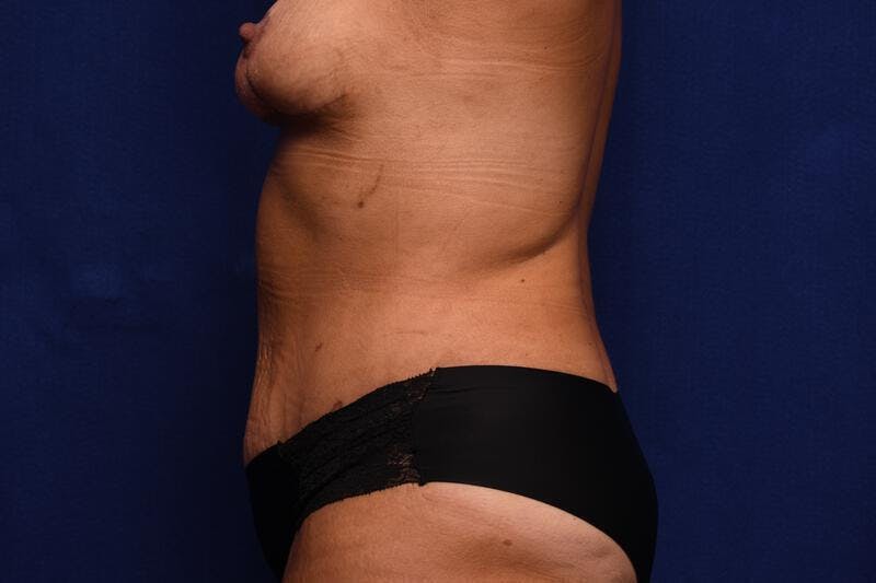 Abdominoplasty Before & After Gallery - Patient 325829 - Image 2