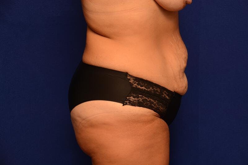 Abdominoplasty Before & After Gallery - Patient 325829 - Image 9