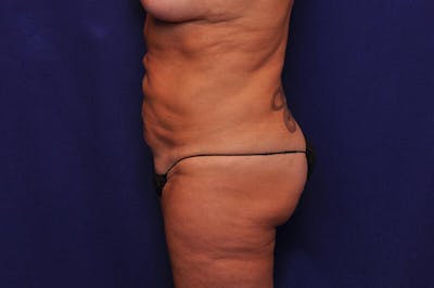 Abdominoplasty Before & After Gallery - Patient 251267 - Image 1