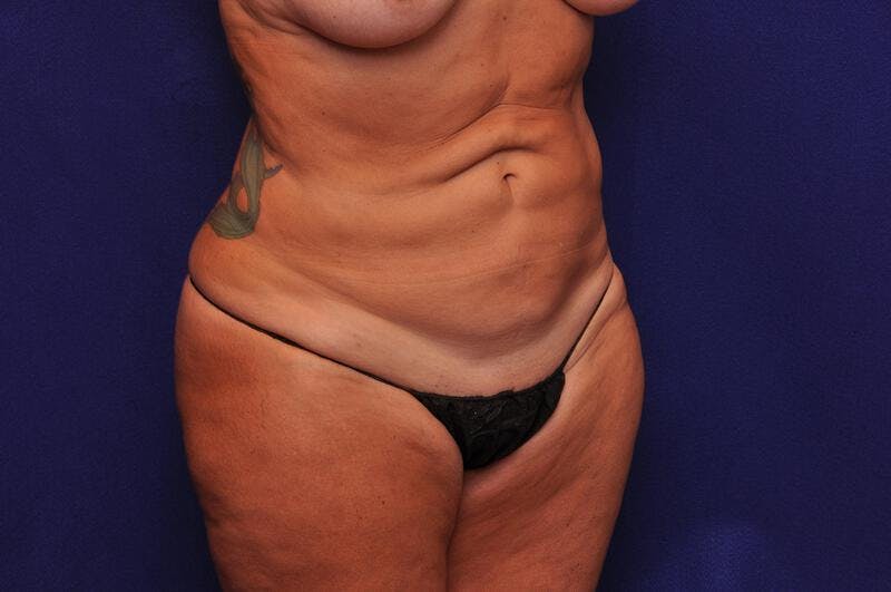 Abdominoplasty Before & After Gallery - Patient 251267 - Image 7