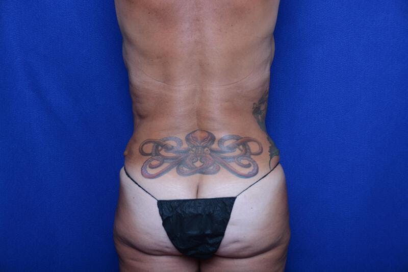 Abdominoplasty Before & After Gallery - Patient 251267 - Image 12