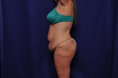 Abdominoplasty Before & After Gallery - Patient 271764 - Image 1