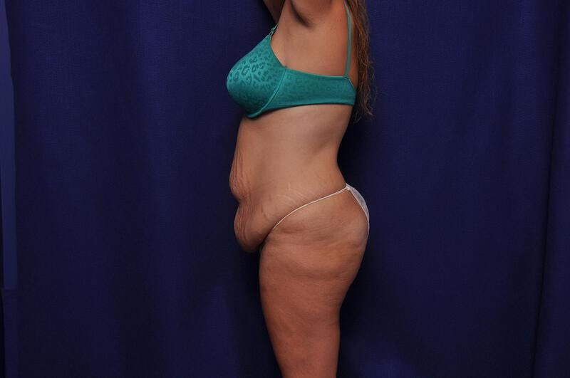Abdominoplasty Before & After Gallery - Patient 271764 - Image 1