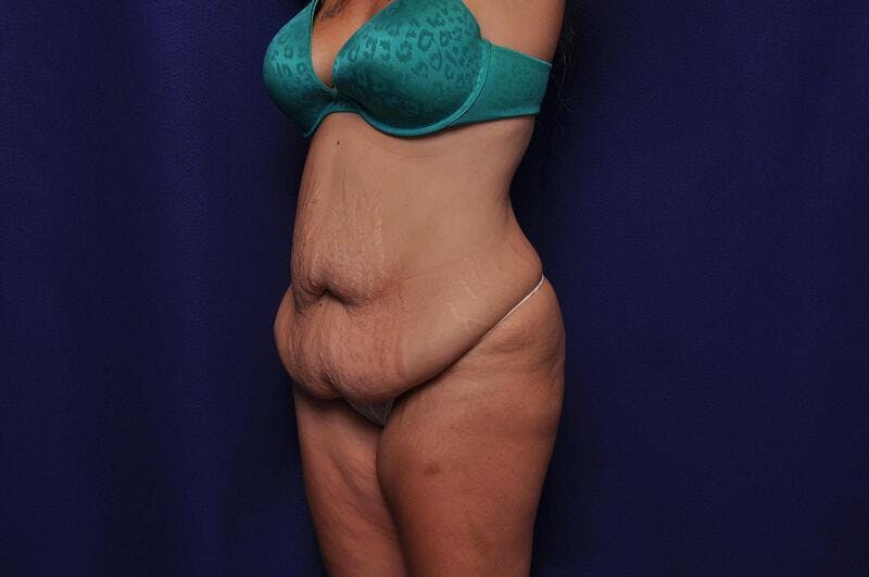 Abdominoplasty Before & After Gallery - Patient 271764 - Image 3