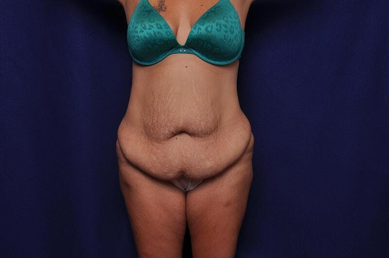 Abdominoplasty Before & After Gallery - Patient 271764 - Image 5