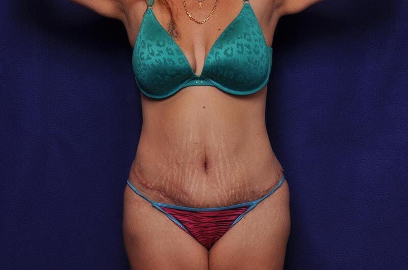 Abdominoplasty Before & After Gallery - Patient 271764 - Image 6
