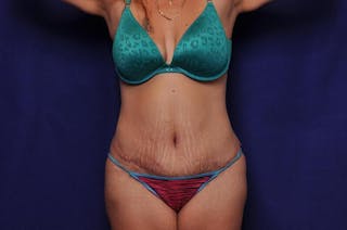Abdominoplasty Before & After Gallery - Patient 271764 - Image 6