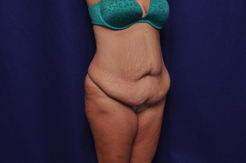Abdominoplasty Before & After Gallery - Patient 271764 - Image 7