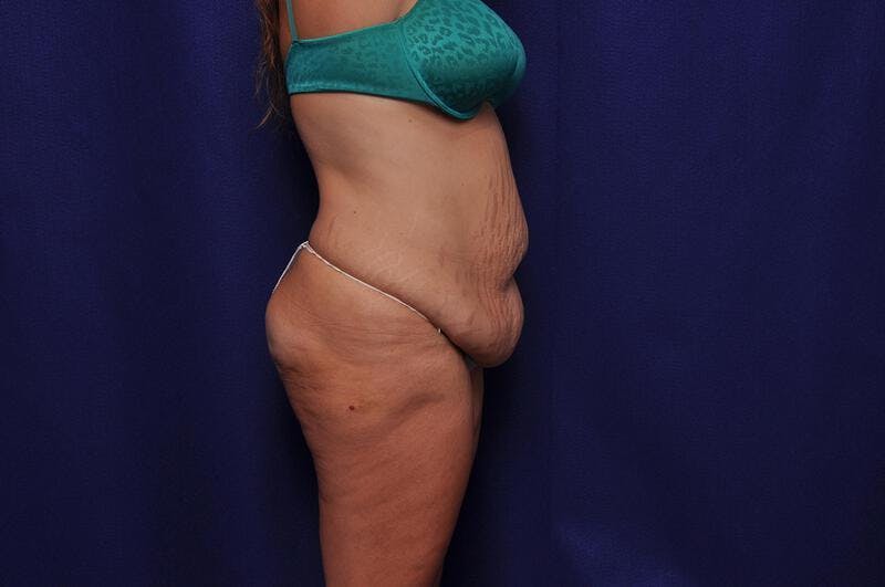 Abdominoplasty Before & After Gallery - Patient 271764 - Image 9