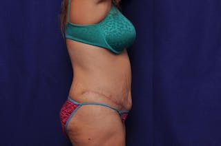 Abdominoplasty Before & After Gallery - Patient 271764 - Image 10