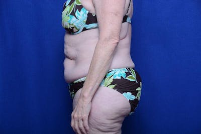 Abdominoplasty Before & After Gallery - Patient 154628 - Image 1