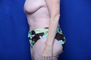 Abdominoplasty Before & After Gallery - Patient 154628 - Image 2