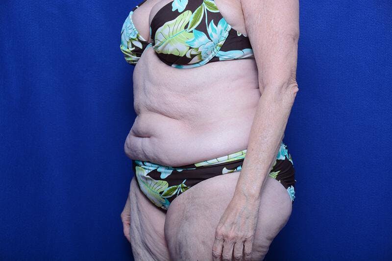 Abdominoplasty Before & After Gallery - Patient 154628 - Image 3