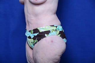 Abdominoplasty Before & After Gallery - Patient 154628 - Image 4