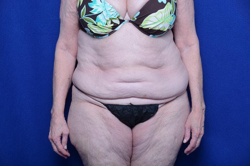 Abdominoplasty Before & After Gallery - Patient 154628 - Image 5