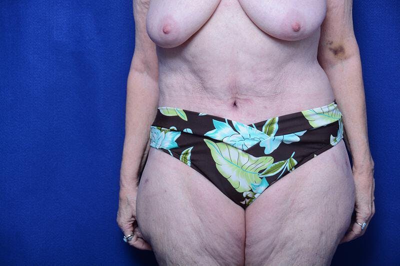 Abdominoplasty Before & After Gallery - Patient 154628 - Image 6