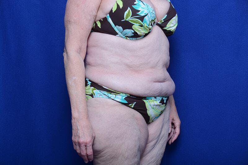 Abdominoplasty Before & After Gallery - Patient 154628 - Image 7