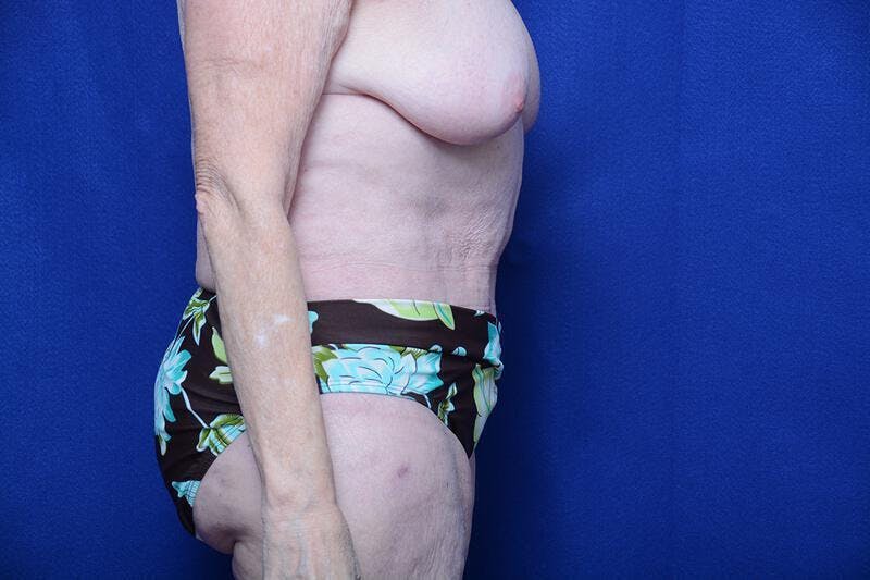 Abdominoplasty Before & After Gallery - Patient 154628 - Image 10