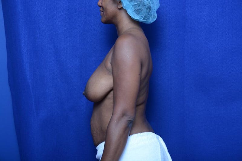 Abdominoplasty Before & After Gallery - Patient 132282 - Image 1
