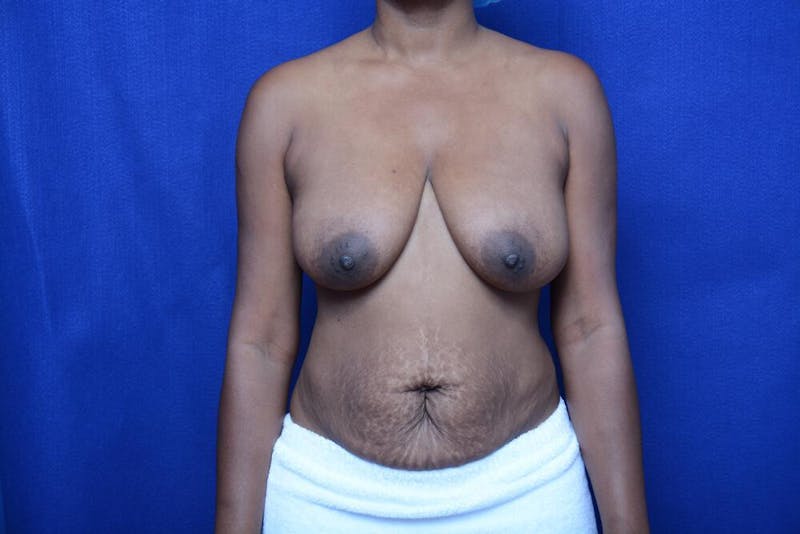 Abdominoplasty Before & After Gallery - Patient 132282 - Image 5