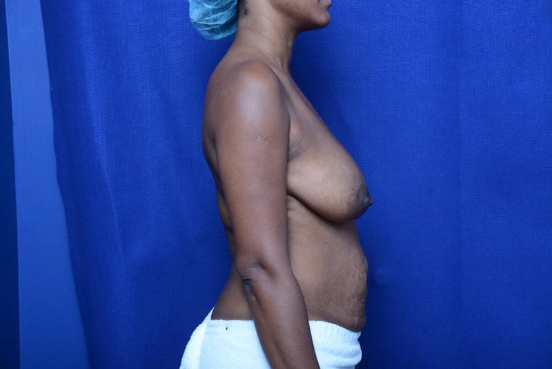 Abdominoplasty Before & After Gallery - Patient 132282 - Image 9