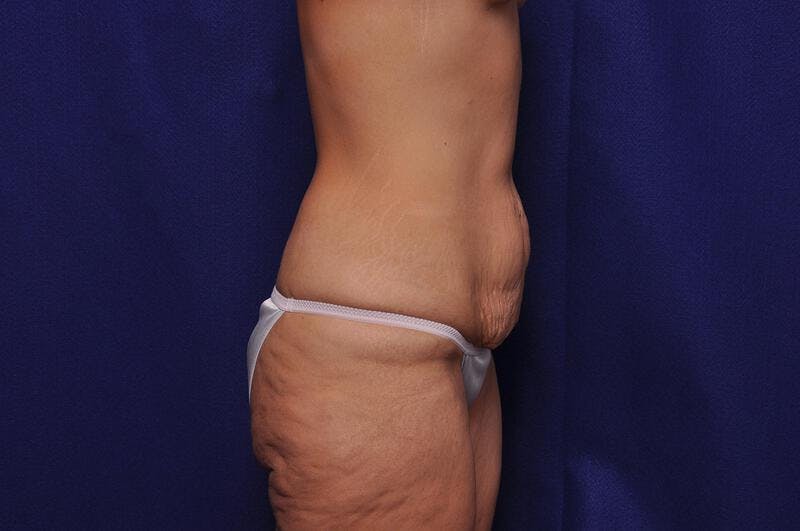 Abdominoplasty Before & After Gallery - Patient 253019 - Image 9