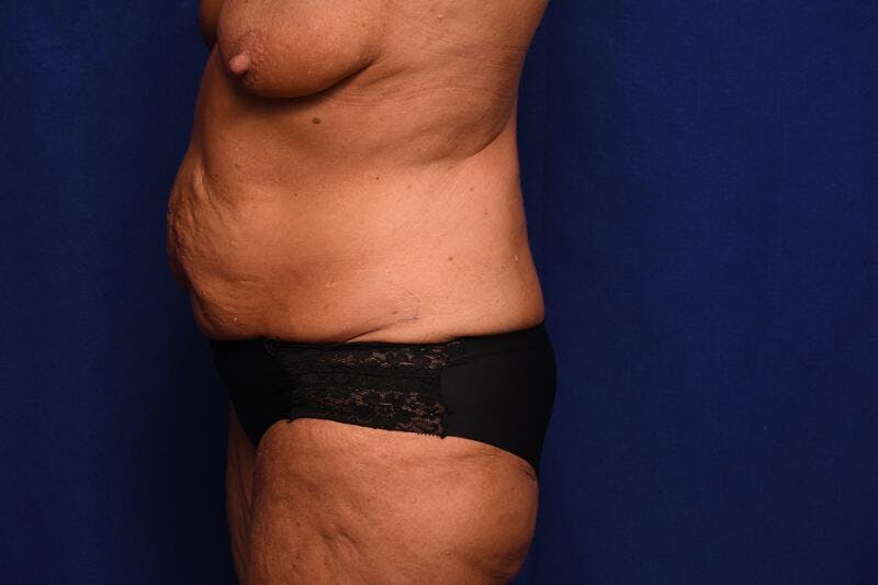 Abdominoplasty Before & After Gallery - Patient 364730 - Image 1
