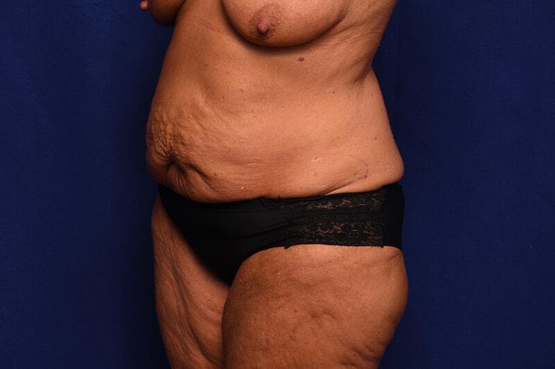 Abdominoplasty Before & After Gallery - Patient 364730 - Image 3