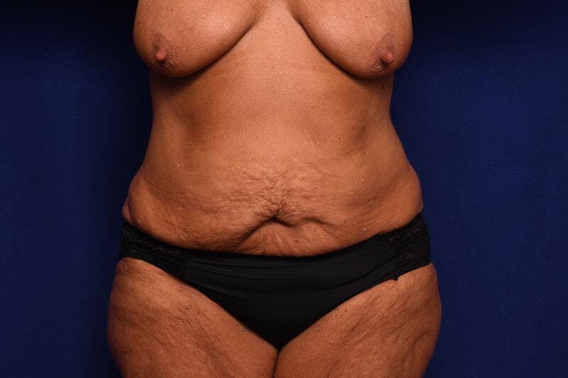 Abdominoplasty Before & After Gallery - Patient 364730 - Image 5